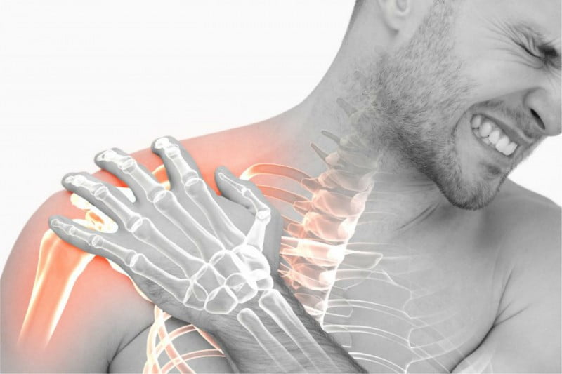 σύνδρομο πρόσκρουσης ώμου | syndrome de conflit d'épaule | shoulder impingement syndrome